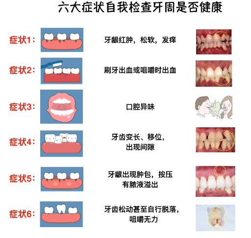 牙周病