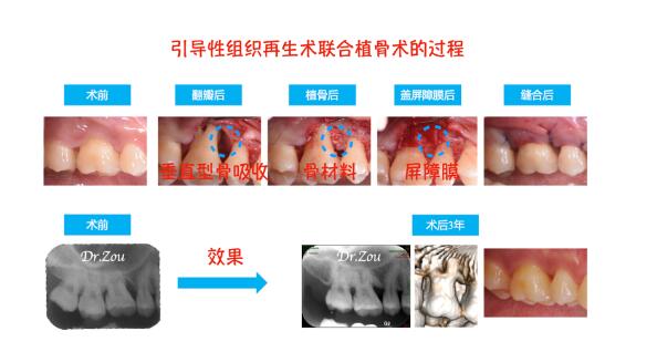 GTR联合植骨术