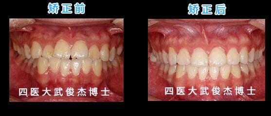 牙颌畸形